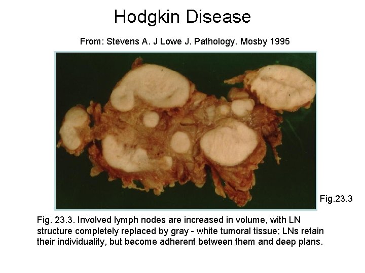 Hodgkin Disease From: Stevens A. J Lowe J. Pathology. Mosby 1995 Fig. 23. 3.