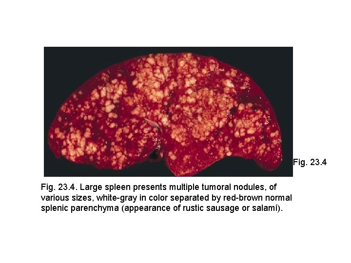 Fig. 23. 4. Large spleen presents multiple tumoral nodules, of various sizes, white-gray in