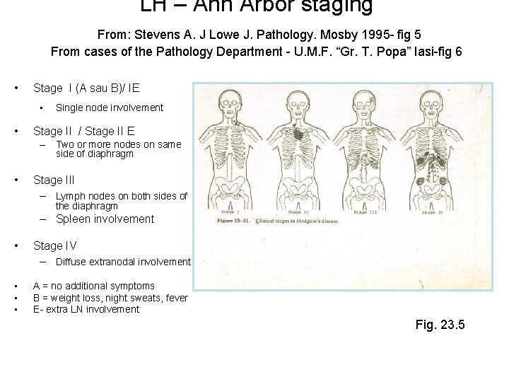 LH – Ann Arbor staging From: Stevens A. J Lowe J. Pathology. Mosby 1995