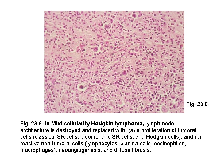 Fig. 23. 6. In Mixt cellularity Hodgkin lymphoma, lymph node architecture is destroyed and