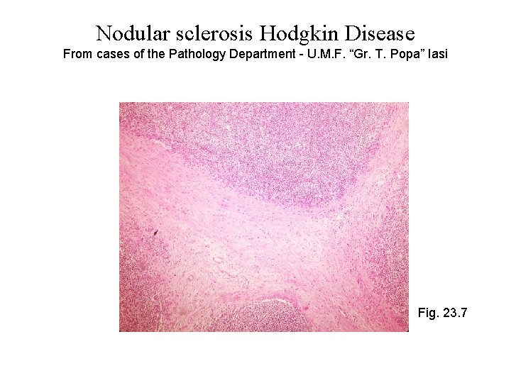 Nodular sclerosis Hodgkin Disease From cases of the Pathology Department - U. M. F.