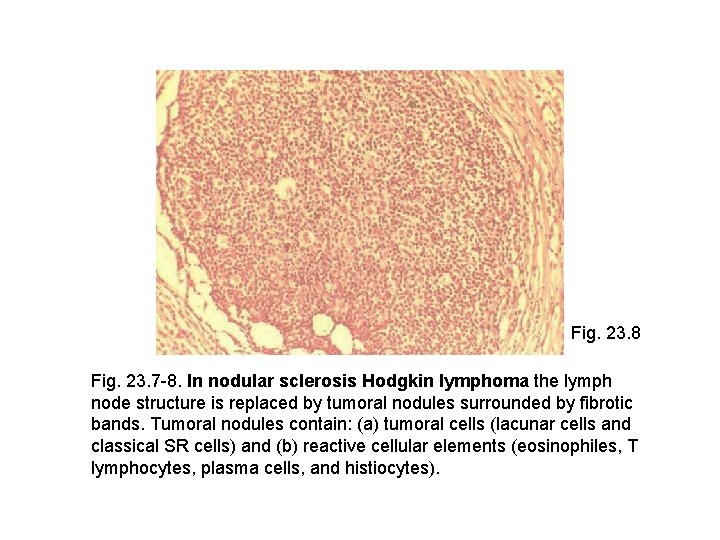 Fig. 23. 8 Fig. 23. 7 -8. In nodular sclerosis Hodgkin lymphoma the lymph