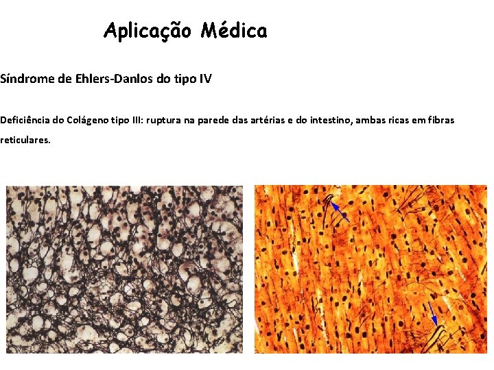 Aplicação Médica Síndrome de Ehlers-Danlos do tipo IV Deficiência do Colágeno tipo III: ruptura