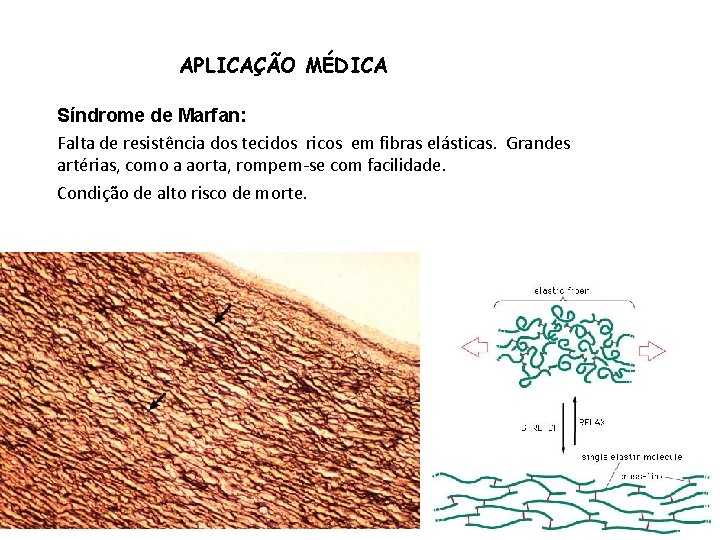 APLICAÇÃO MÉDICA Síndrome de Marfan: Falta de resistência dos tecidos ricos em fibras elásticas.