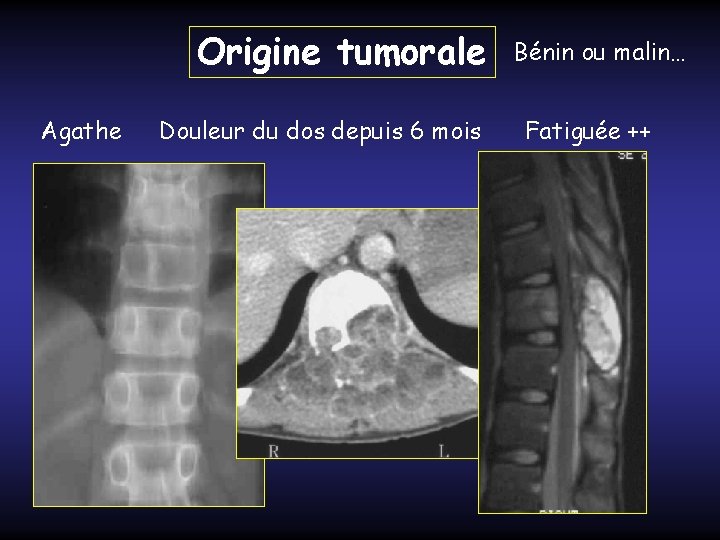 Origine tumorale Agathe Douleur du dos depuis 6 mois Bénin ou malin… Fatiguée ++