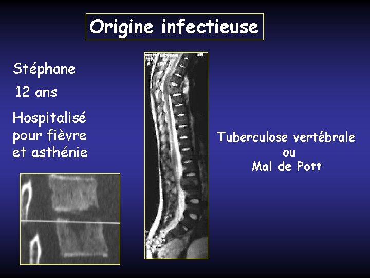 Origine infectieuse Stéphane 12 ans Hospitalisé pour fièvre et asthénie Tuberculose vertébrale ou Mal