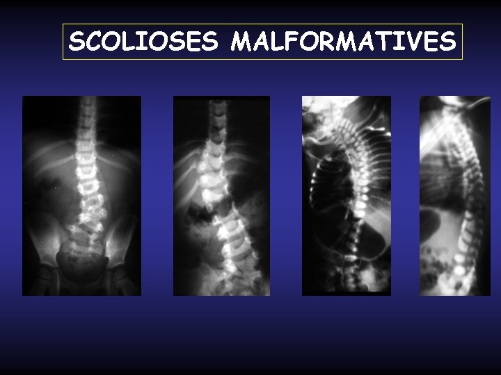 SCOLIOSES MALFORMATIVES 