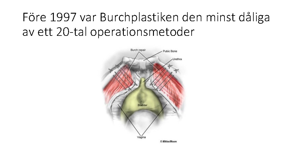Före 1997 var Burchplastiken den minst dåliga av ett 20 -tal operationsmetoder 