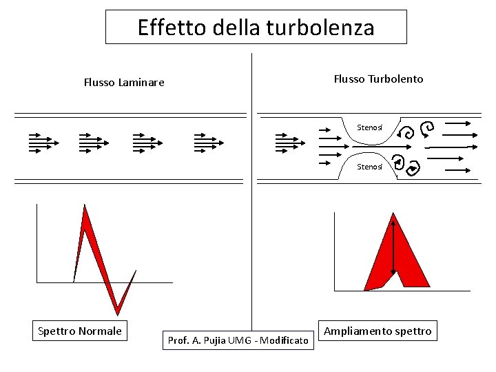 Effetto della turbolenza Flusso Turbolento Flusso Laminare Stenosi Spettro Normale Prof. A. Pujia UMG