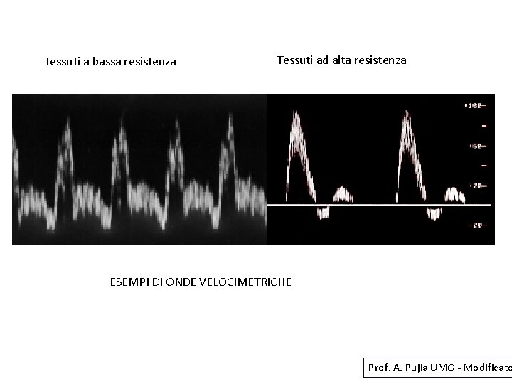 Tessuti a bassa resistenza Tessuti ad alta resistenza ESEMPI DI ONDE VELOCIMETRICHE Prof. A.
