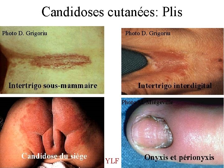 Candidoses cutanées: Plis Photo D. Grigoriu Photo M. Miégeville YLF 