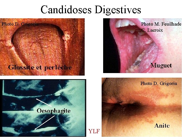 Candidoses Digestives Photo D. Grigoriu Photo M. Feuilhade C. Lacroix Photo D. Grigoriu YLF