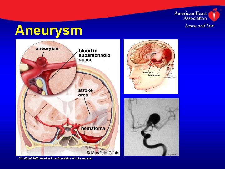 Aneurysm 5/21/2021© 2009, American Heart Association. All rights reserved. 