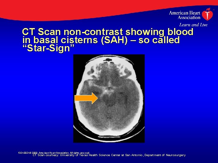 CT Scan non-contrast showing blood in basal cisterns (SAH) – so called “Star-Sign” 5/21/2021©