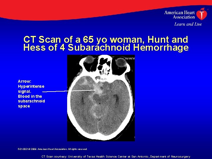 CT Scan of a 65 yo woman, Hunt and Hess of 4 Subarachnoid Hemorrhage