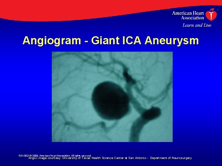 Angiogram - Giant ICA Aneurysm 5/21/2021© 2009, American Heart Association. All rights reserved. Angio