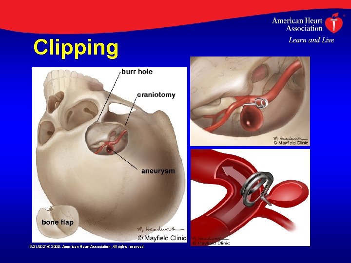 Clipping 5/21/2021© 2009, American Heart Association. All rights reserved. 