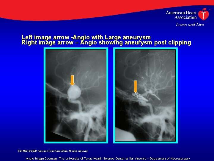 Left image arrow -Angio with Large aneurysm Right image arrow – Angio showing aneurysm