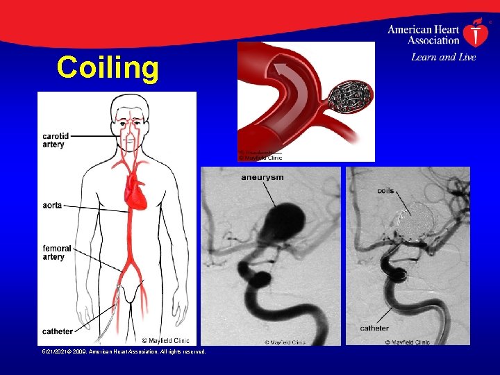 Coiling 5/21/2021© 2009, American Heart Association. All rights reserved. 