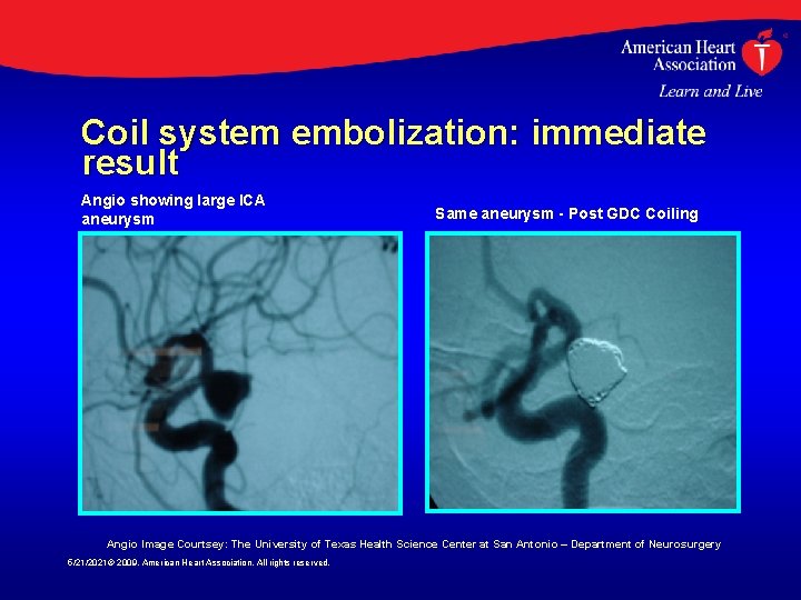 Coil system embolization: immediate result Angio showing large ICA aneurysm Same aneurysm - Post