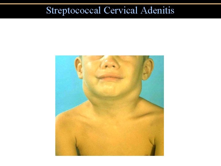 Streptococcal Cervical Adenitis 
