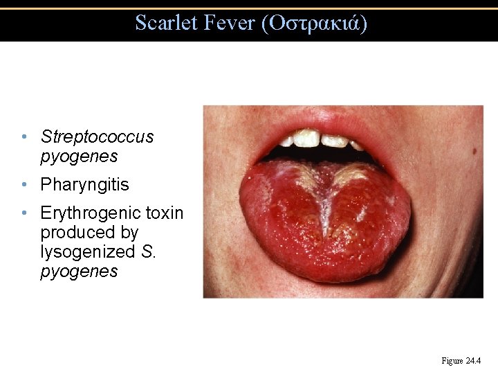 Scarlet Fever (Οστρακιά) • Streptococcus pyogenes • Pharyngitis • Erythrogenic toxin produced by lysogenized
