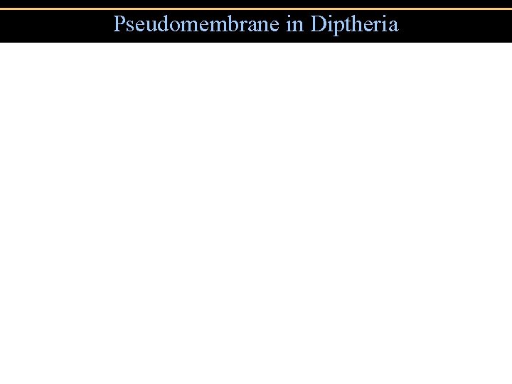 Pseudomembrane in Diptheria 