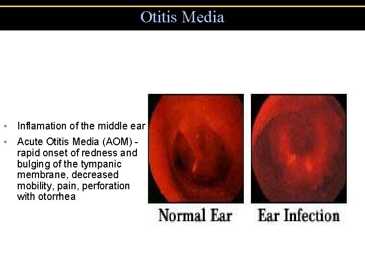 Otitis Media • Inflamation of the middle ear • Acute Otitis Media (AOM) rapid
