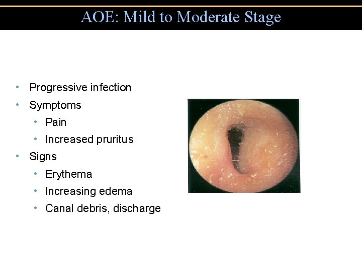 AOE: Mild to Moderate Stage • Progressive infection • Symptoms • Pain • Increased