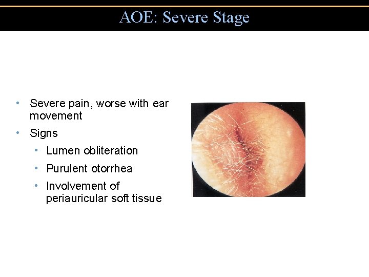 AOE: Severe Stage • Severe pain, worse with ear movement • Signs • Lumen