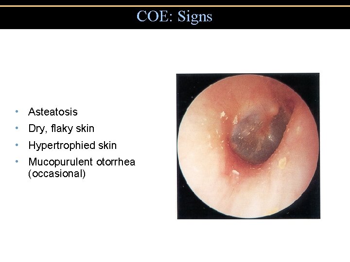 COE: Signs • Asteatosis • Dry, flaky skin • Hypertrophied skin • Mucopurulent otorrhea