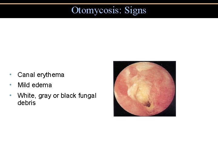Otomycosis: Signs • Canal erythema • Mild edema • White, gray or black fungal