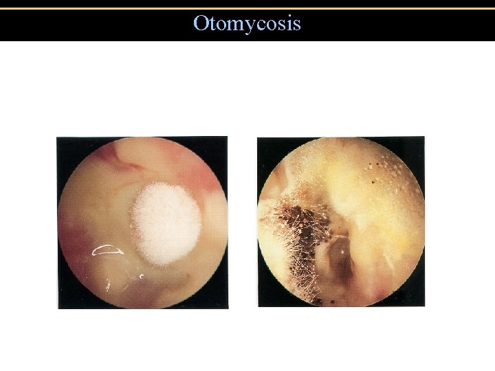 Otomycosis 