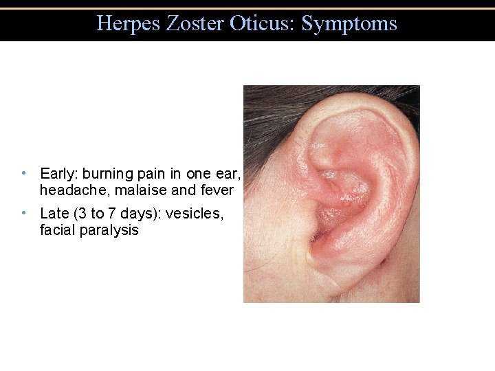 Herpes Zoster Oticus: Symptoms • Early: burning pain in one ear, headache, malaise and