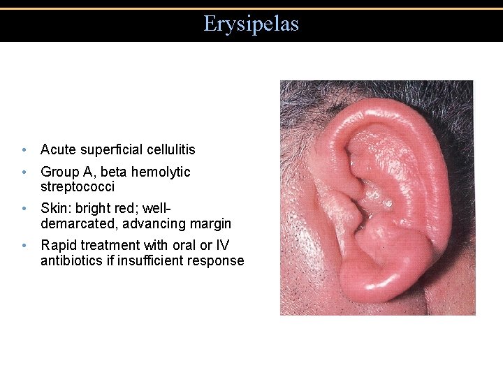 Erysipelas • Acute superficial cellulitis • Group A, beta hemolytic streptococci • Skin: bright
