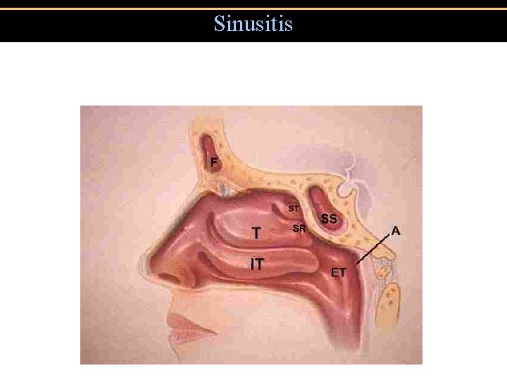 Sinusitis 