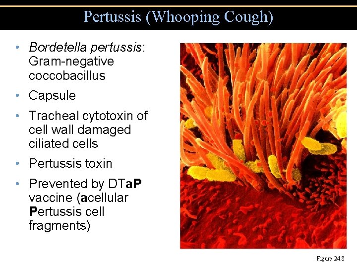 Pertussis (Whooping Cough) • Bordetella pertussis: Gram-negative coccobacillus • Capsule • Tracheal cytotoxin of