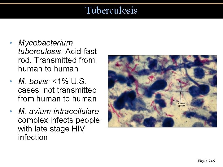 Tuberculosis • Mycobacterium tuberculosis: Acid-fast rod. Transmitted from human to human • M. bovis: