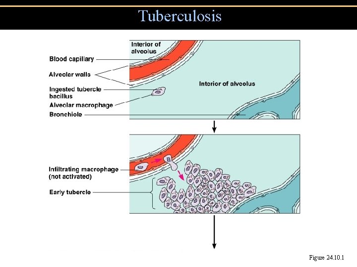 Tuberculosis Figure 24. 10. 1 