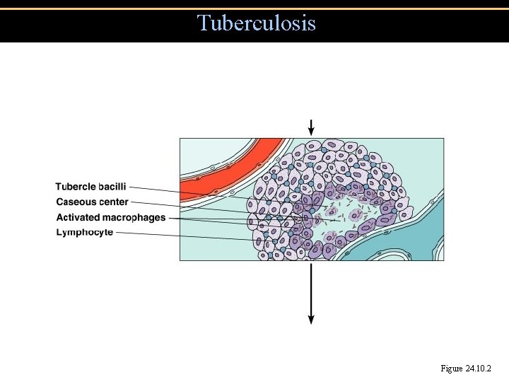 Tuberculosis Figure 24. 10. 2 