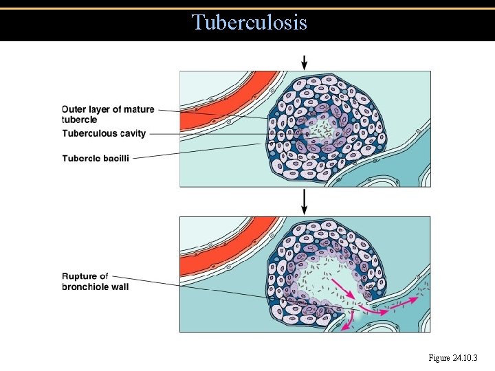 Tuberculosis Figure 24. 10. 3 