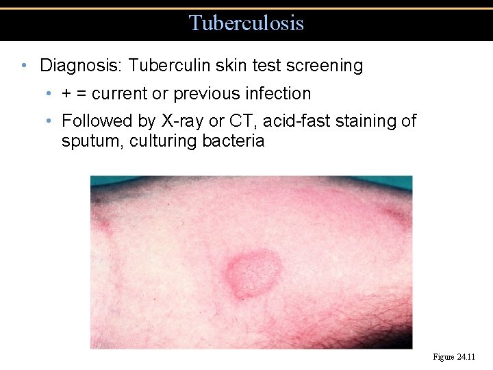 Tuberculosis • Diagnosis: Tuberculin skin test screening • + = current or previous infection