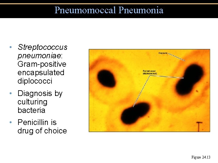 Pneumomoccal Pneumonia • Streptococcus pneumoniae: Gram-positive encapsulated diplococci • Diagnosis by culturing bacteria •