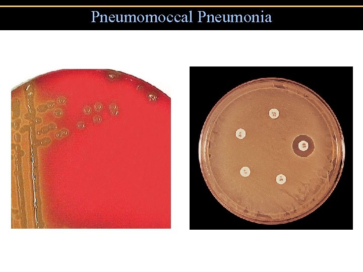 Pneumomoccal Pneumonia 