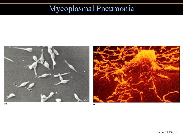Mycoplasmal Pneumonia Figure 11. 19 a, b 