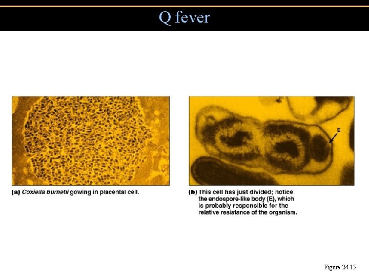 Q fever Figure 24. 15 