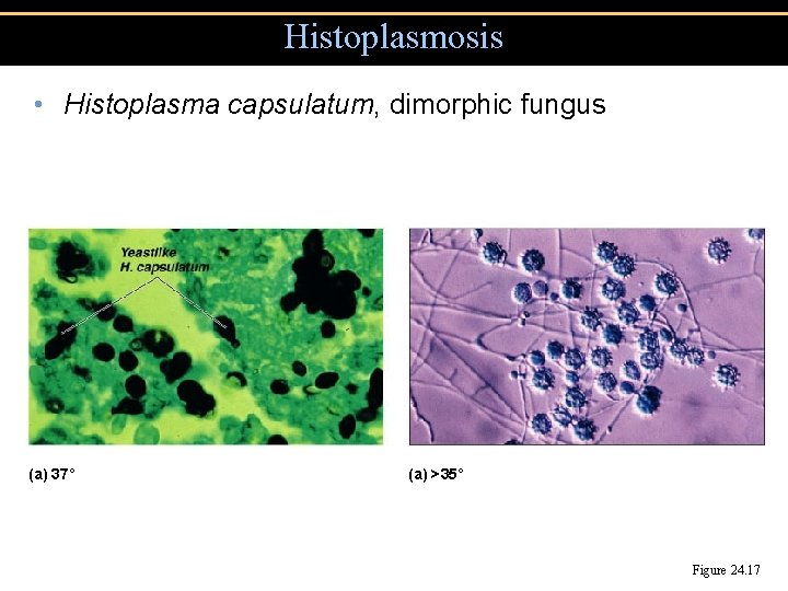 Histoplasmosis • Histoplasma capsulatum, dimorphic fungus (a) 37˚ (a) >35˚ Figure 24. 17 