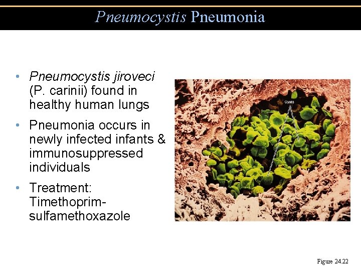 Pneumocystis Pneumonia • Pneumocystis jiroveci (P. carinii) found in healthy human lungs • Pneumonia