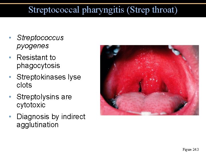 Streptococcal pharyngitis (Strep throat) • Streptococcus pyogenes • Resistant to phagocytosis • Streptokinases lyse