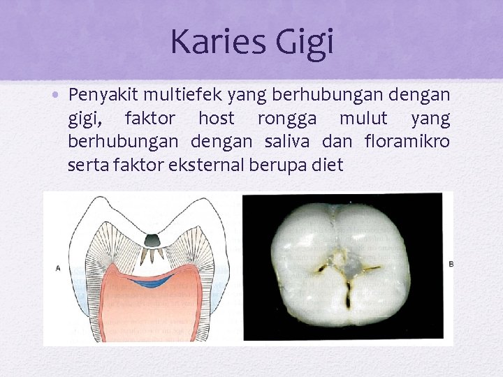 Karies Gigi • Penyakit multiefek yang berhubungan dengan gigi, faktor host rongga mulut yang